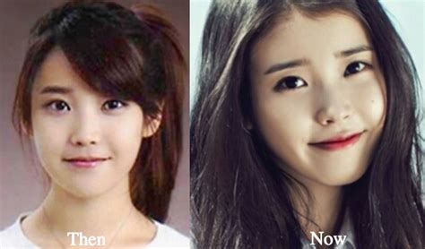 Iu Plastic Surgery Before And After Photos Latest Plastic Surgery