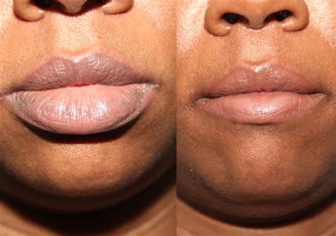 lip reduction lip augmentation in toronto dr solomon
