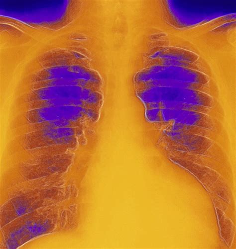 Coloured Chest X Ray Of Ventricular Cardiomyopathy Photograph By
