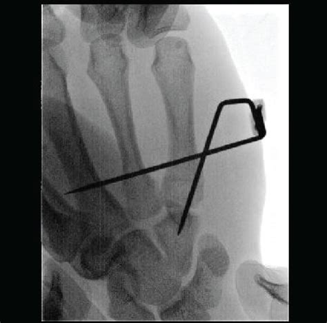 A 15 Mm Fixator Pin Was Inserted From The Base Of The Fifth Metacarpal Download Scientific