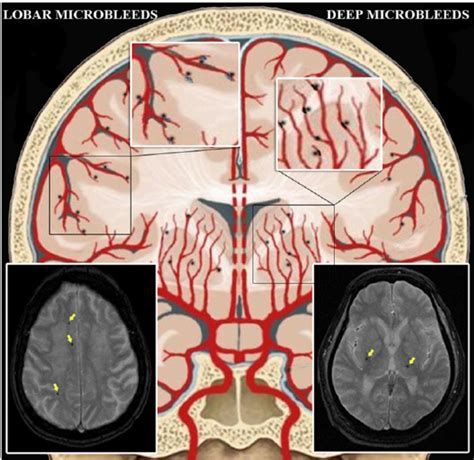 The Topography Of Cerebral Microbleeds And Their Magnetic Resonance