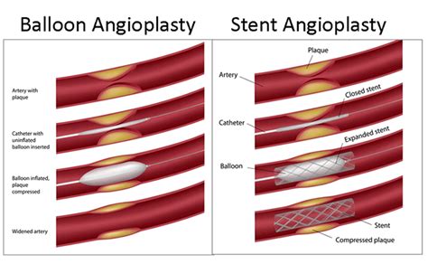Balloon And Stent Angioplasty Diagrams And A Short Illustrated Video Of