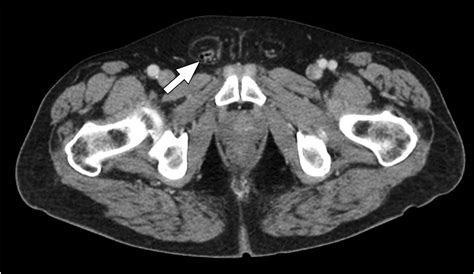 Cureus Inguinal Hernia Containing An Inflamed Appendix A Case Of