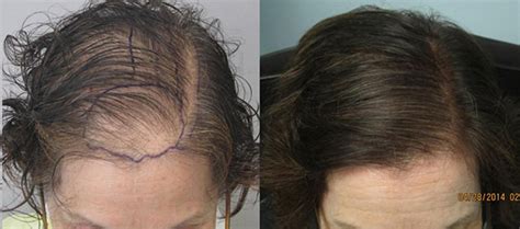 Hair transplants are a popular hair treatment method, but they're also one of the most expensive. Womens Before and After Hair Transplant Photos