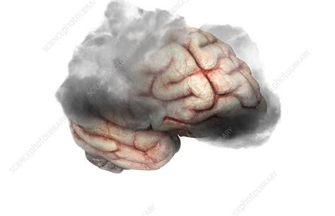Depression Stock Image F0024430 Science Photo Library