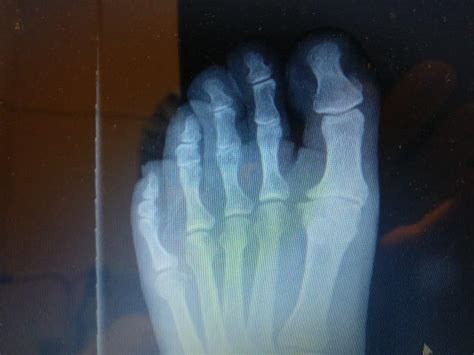 Hallux Rigidus Big Toe Arthritis Podiatrists And Foot Doctors