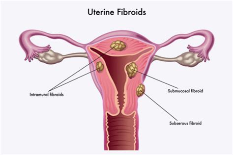 Fibroids The Pelvic Clinic