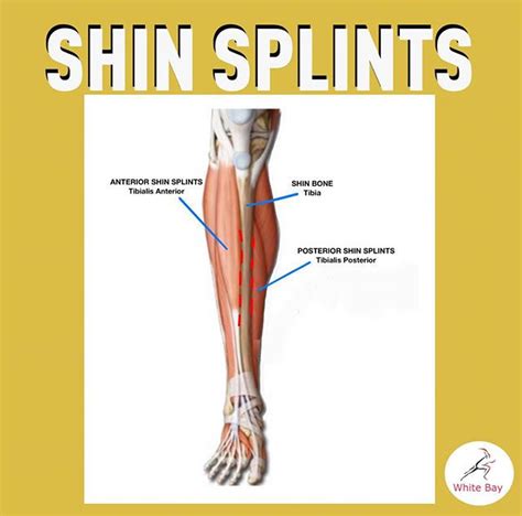 Shin Splints While Running Learn How To Manage This Problem