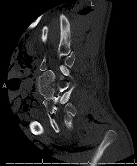 Axial Ct Myelogram At The Level Of The T1 T2 Neural Foramen With The