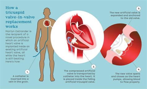 Advances In Heart Valve Replacement Technology Are Providing New Hope