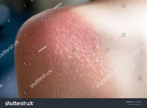 Sunburn Blisters Images Stock Photos And Vectors Shutterstock