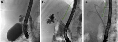 E Series Of Ercp A With Subsequent Insertion Of 4 Draining Stents