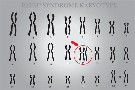 Síndrome De Patau Trissomia 13 O Que é Sintomas E Cariótipo Dasa Genômica