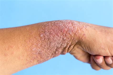 Dermatite Delle Mani Eczema A Portata Di Mano Fotografie Stock E
