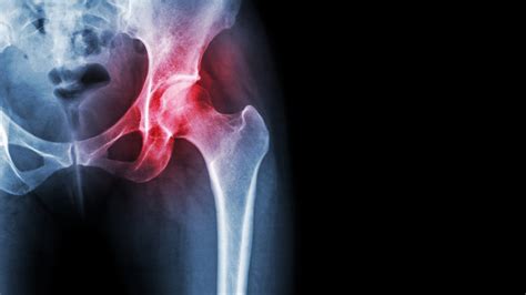 Infected Hip Replacement Causes Symptoms And Treatment Brandon