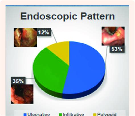 Endoscopic Pattern Of Primary Gastric Malt Lymphomas Download
