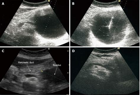 Appearance On Ultrasound Of A Pancreatic Pseudocyst Before During And