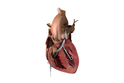 About Impella® Heart Pumps Abiomed