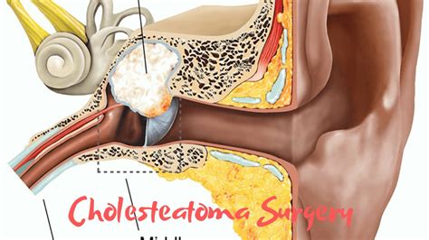 Cholesteatoma Surgery Youtube