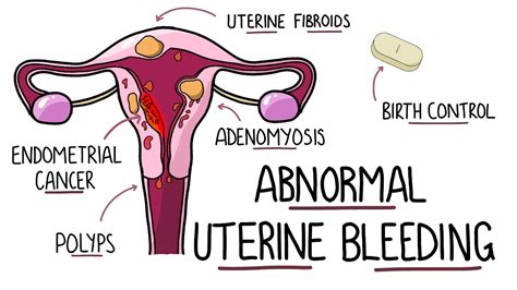 Abnormal Uterine Bleeding Aub Menorrhagia Heavy Menstrual