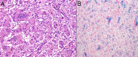 A Haematoxylin Eosin Stain Giant Cell Hepatitis With Extensive