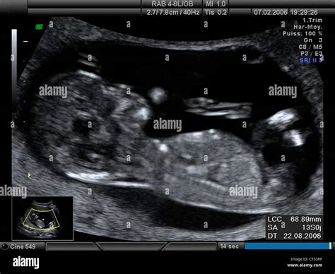 3 Month Pregnancy Ultrasound Report Pregnancywalls