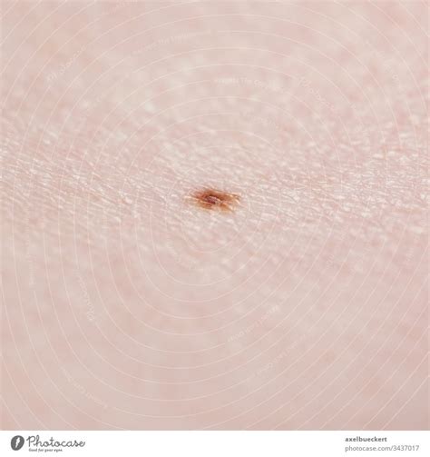 Skin With Mole Dermatology A Royalty Free Stock Photo From Photocase