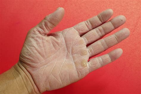 Dry Skin On Hands