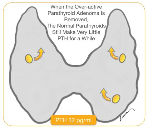Over Active Parathyroid Adenoma Is Removed And Normal Parathyroids
