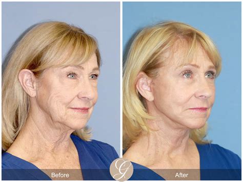 Neck Lift 413 Before After Photos Orange County