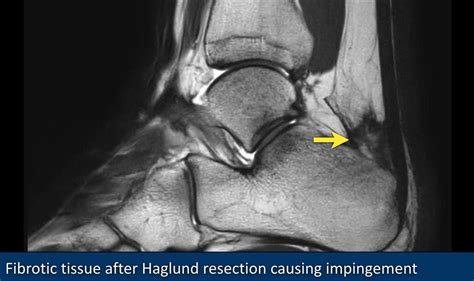 Haglund Syndrome Radiology Haglund S Deformity Treatment Youtube Insertional Achilles