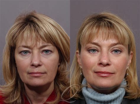 Mid Facelift For Rochester Buffalo Syracuse NY Quatela Center For Plastic Surgery