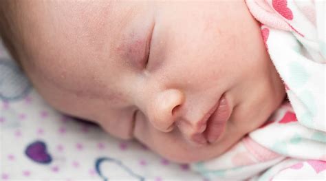 Stork Bite Birthmarks Appearance Causes And More