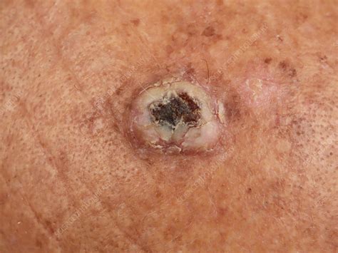 Squamous Cell Carcinoma Skin Cancer Types