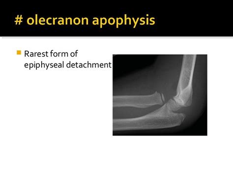 Apophyseal Injuries Of Elbow Medial Epicondyle Avulsion Fractures