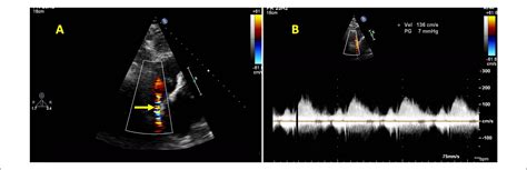 Superior Vena Cava Syndrome After Radiofrequency Catheter Ablation For