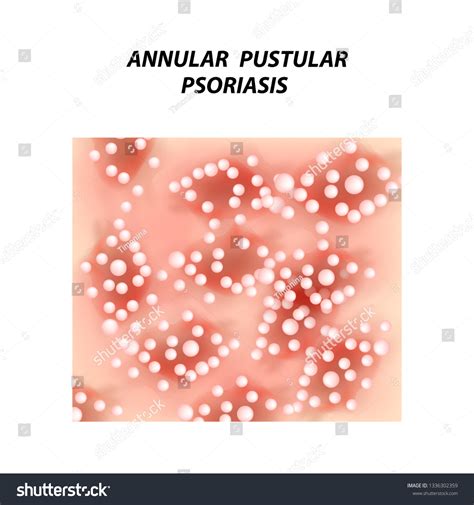 Annular Pustular Psoriasis Eczema Dermatitis Skin Stock Illustration