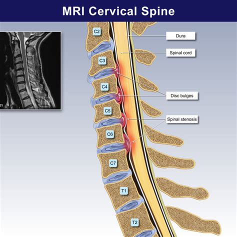 Cervical Mri Trialexhibits Inc 361