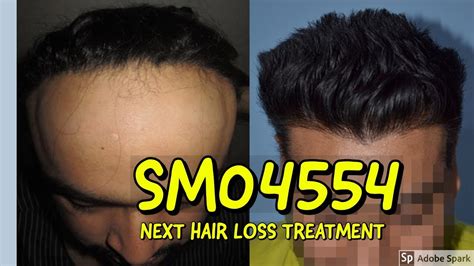 Hair loss prevention and treatment may involve minoxidil (rogaine) or finasteride (propecia). SM04554 - BEST HAIR LOSS TREATMENT? - YouTube