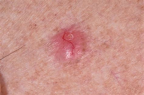 Basal Cell Carcinoma Skin Cancer Stock Image C0345466 Science