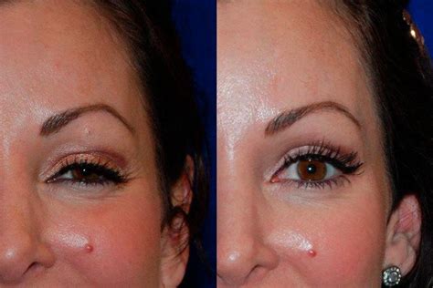Botox brow lift before and after photos. Botox Santa Rosa - Botox Injections in Santa Rosa | Artemedica