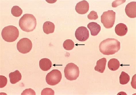 3 Peripheral Blood Film Showing Spherocytes In A Case Of Hereditary