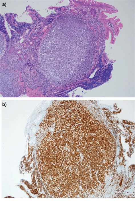 Figure 1 From Endoscopic Findings Of Primary Follicular Lymphoma