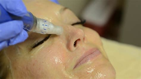 Microneedling With The Skinpen The Skin Center Youtube