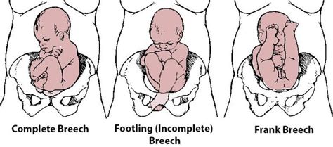 Breech Baby Causes What Does It Mean And How To Turn A Breech Baby