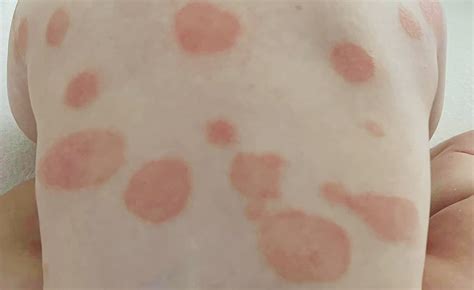 Nummular Eczema And Its Treatment