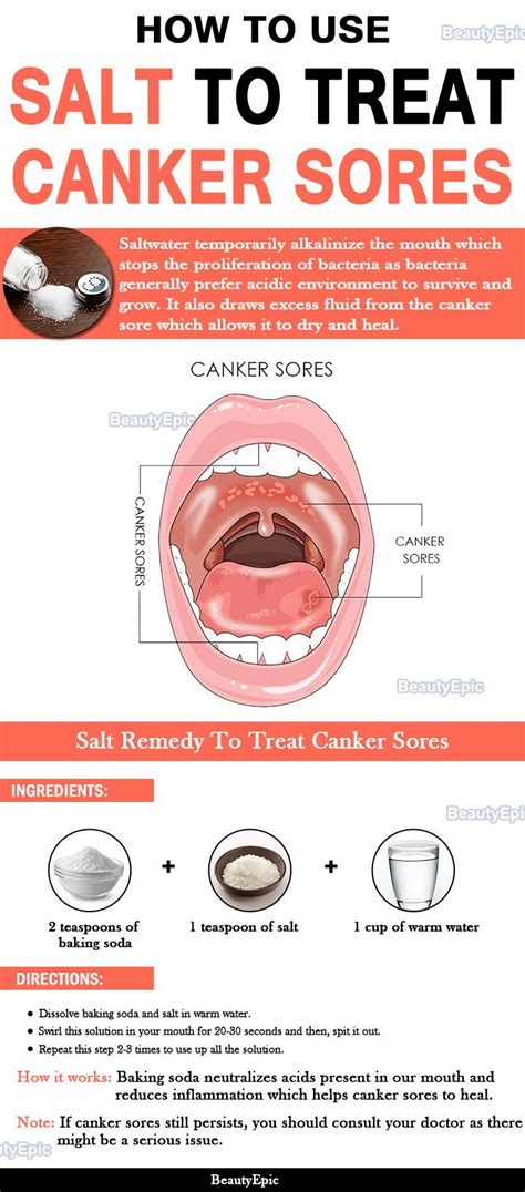 How To Heal Tongue Canker Sores Heal Info