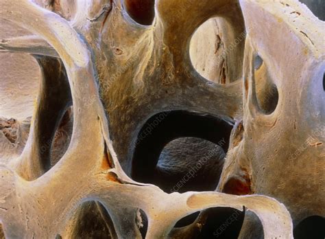 Coloured Sem Of Femoral Spongy Bone Stock Image P1050091 Science