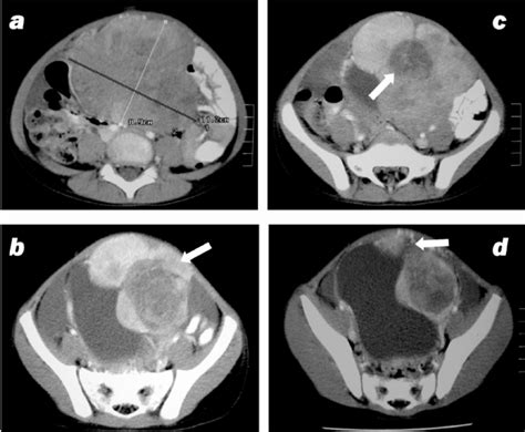Abdominopelvic Ct Scan Revealed A Multilobed Heterogeneous Mass With