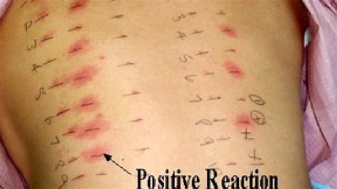 Researchers Allergy Tests Not Always Accurate